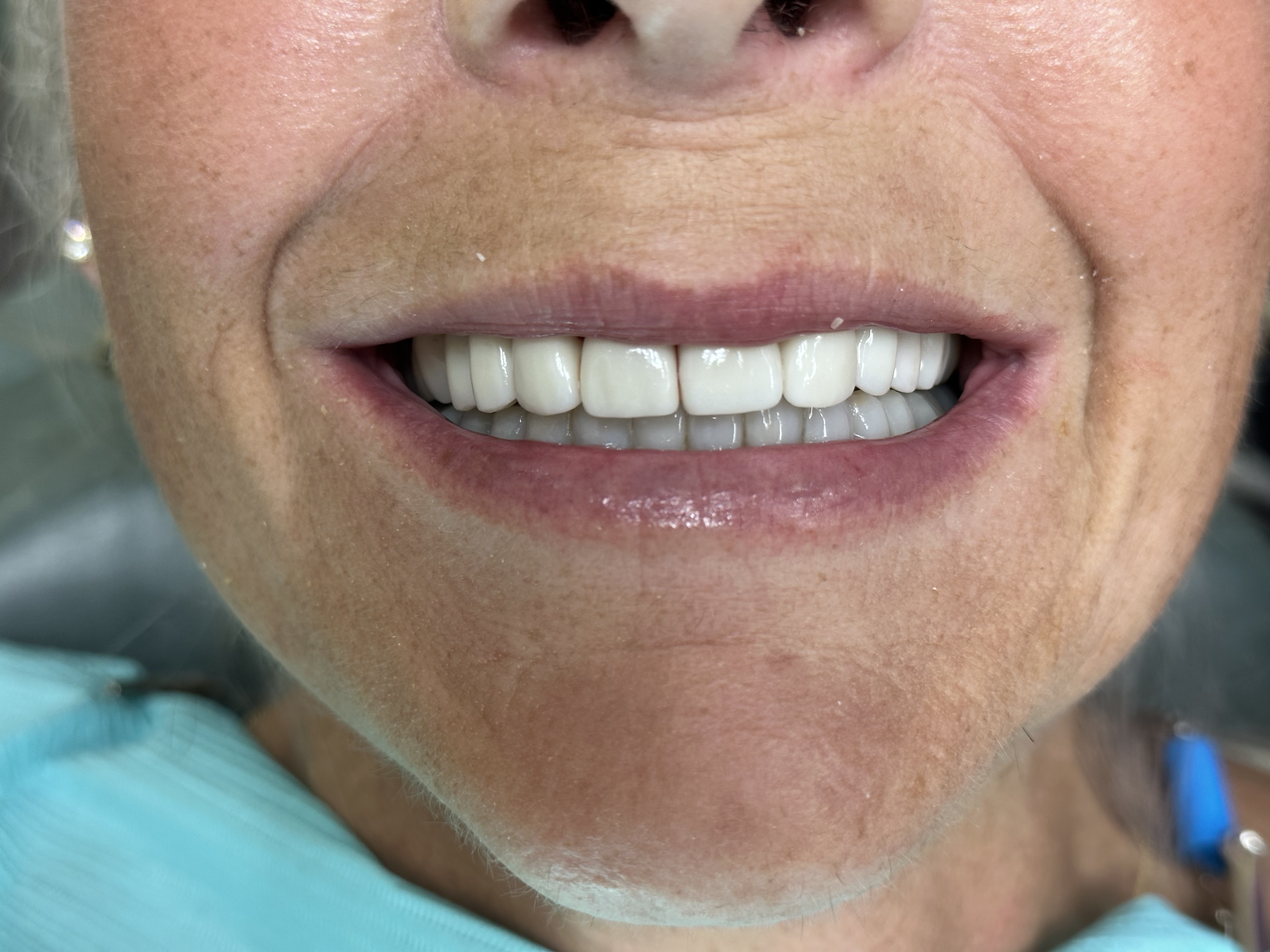 After veneers